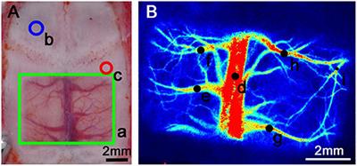 Cerebral Blood Flow Disorder in Acute Subdural Hematoma and Acute Intraoperative Brain Bulge